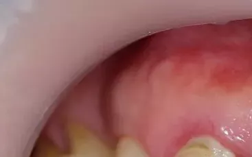 Tænder med parodentose og tandsten