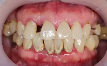 Tænder med parodentose og tandsten